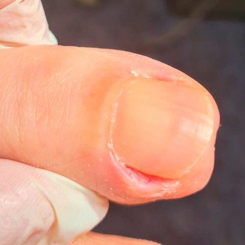 Uñas encarnadas Tratamiento Oviedo