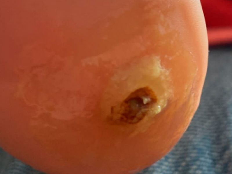 Tratamiento papiloma pie