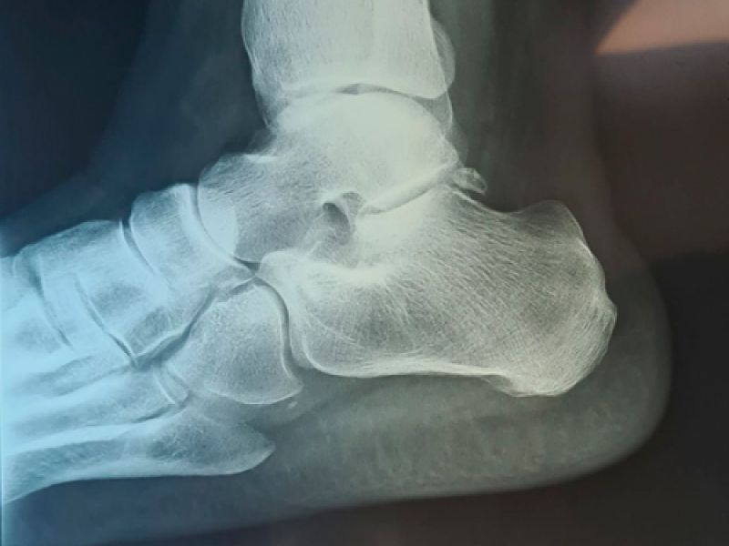 Radiografia ecografia pie Oviedo