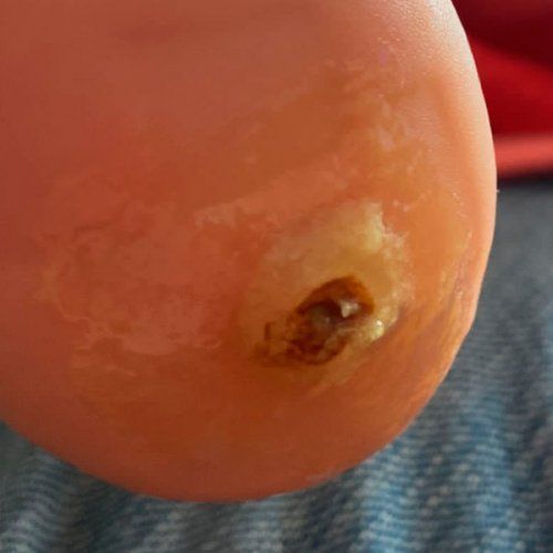 Tratamiento Papilomas pie