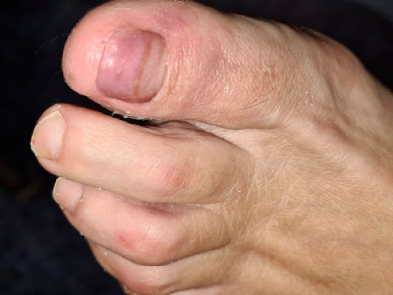 Reconstruccion uña pie