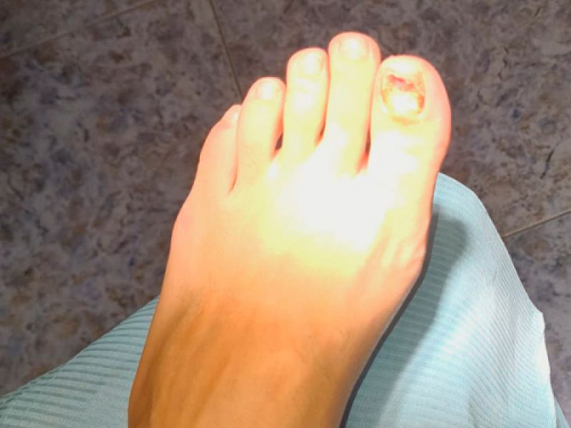 Tratamiento hongos uñas