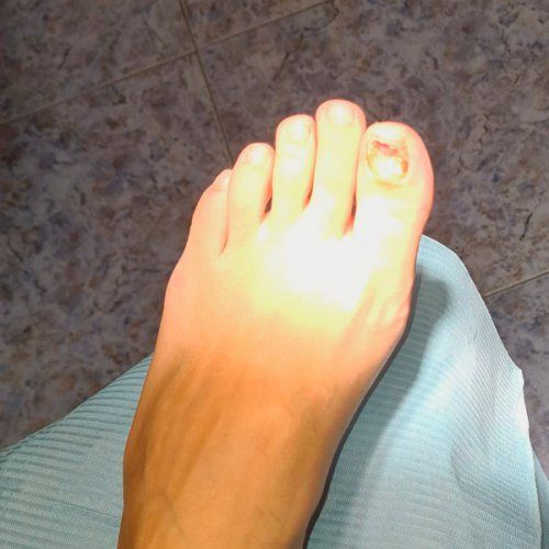 Tratamiento hongos uña en Oviedo