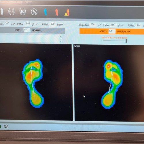 Estudio biomecánico e informatizado de la marcha