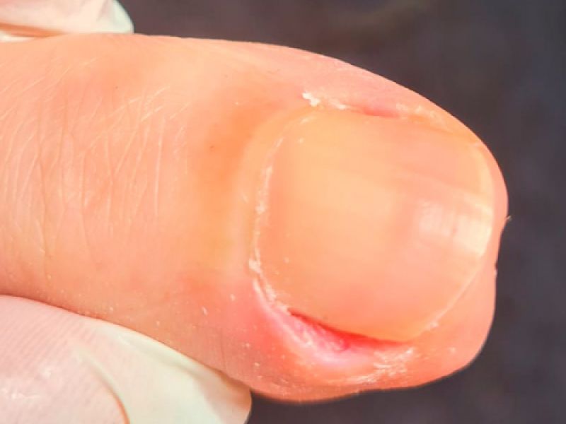 Uña encarnada tratamiento